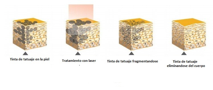 fotorejuvenecimiento